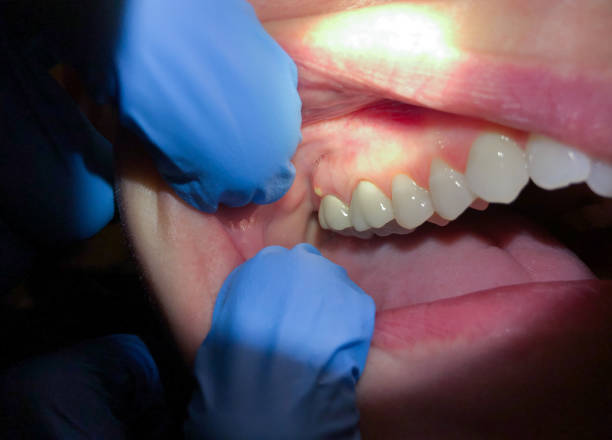 Best Dentist for Tooth Abscess  in Blooming Prairie, MN